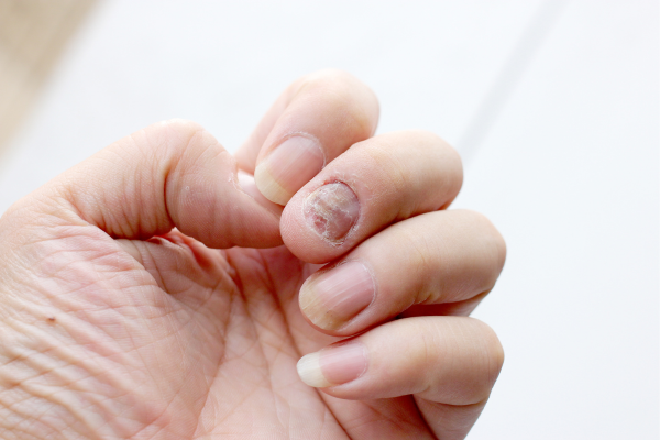 Tratamento Caseiro para Fungos nas Unhas dos Pés ou Mãos